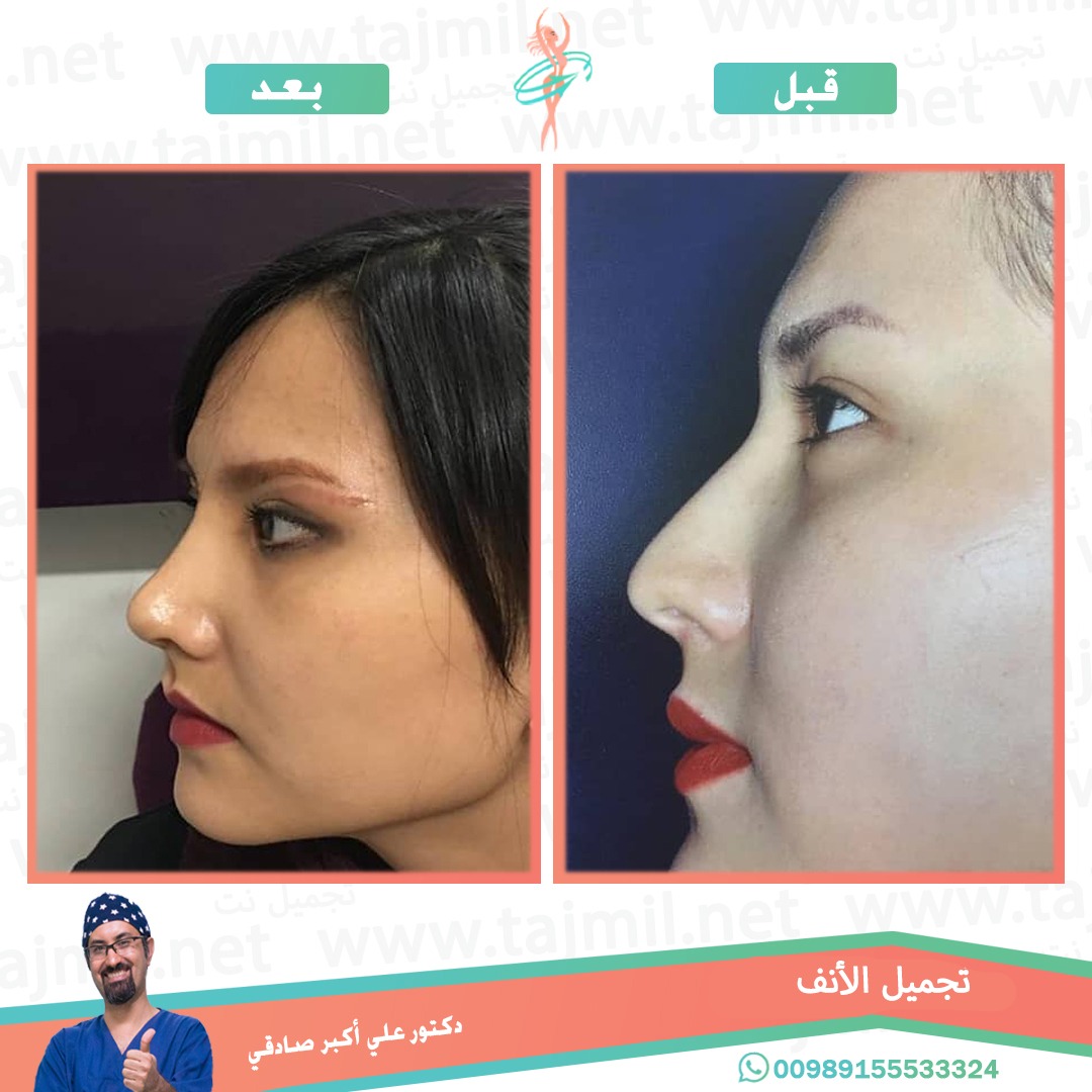  - دكتور علي أکبر صادقي عملية تجميل الانف في ايران مع تجميل نت