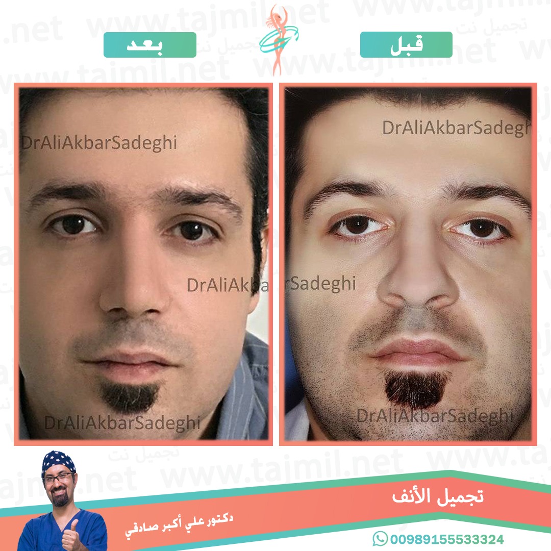  - دكتور علي أکبر صادقي عملية تجميل الانف في ايران مع تجميل نت