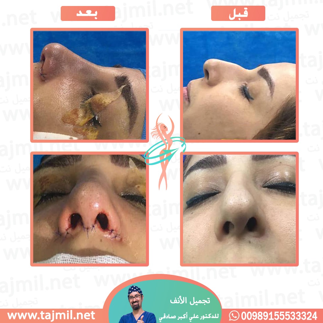  - دكتور علي أکبر صادقي عملية تجميل الانف في ايران مع تجميل نت