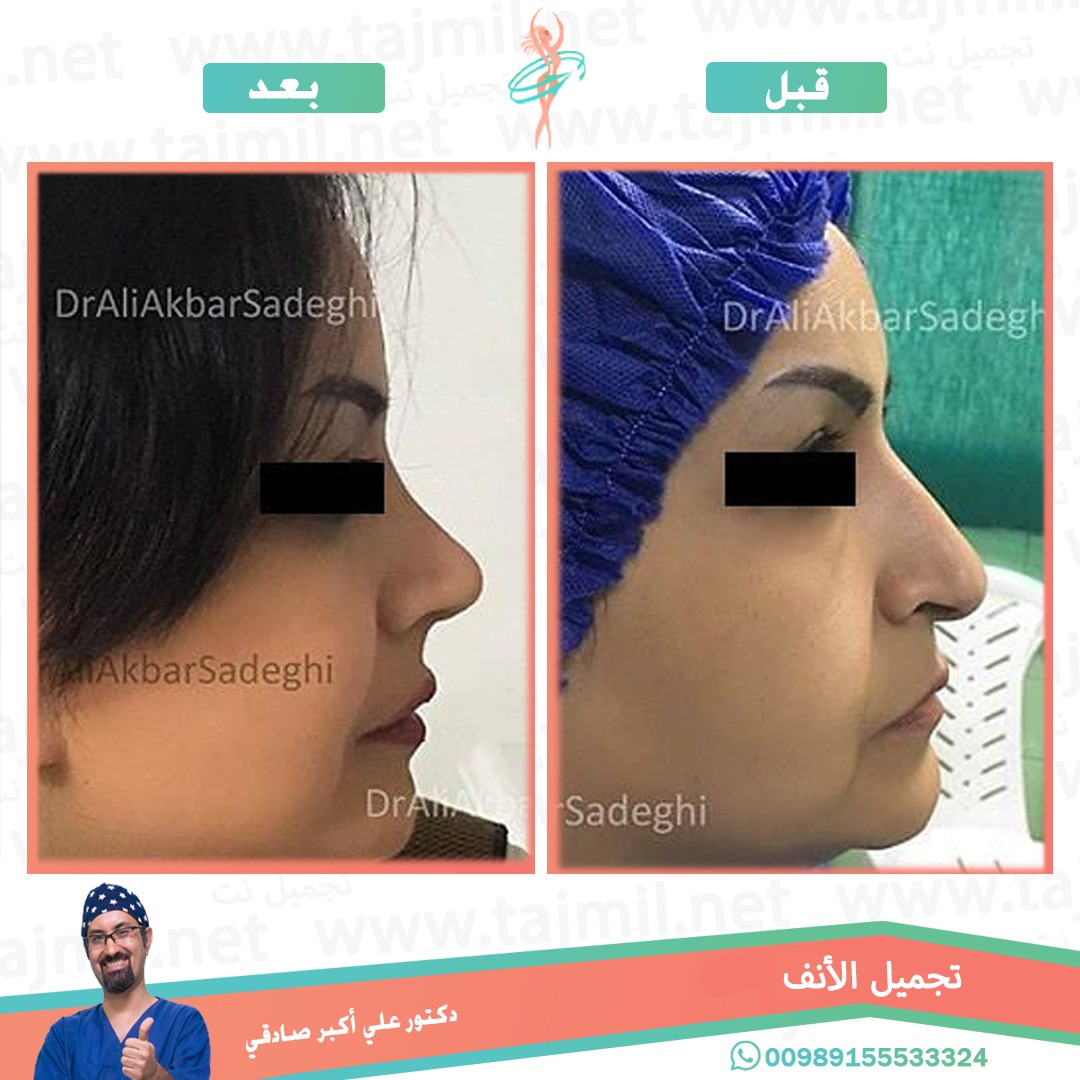  - دكتور علي أکبر صادقي عملية تجميل الانف في ايران مع تجميل نت