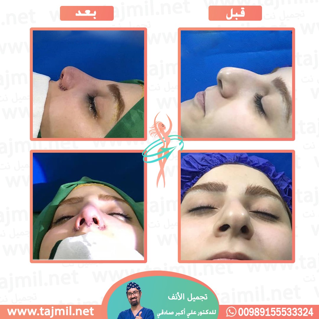  - دكتور علي أکبر صادقي عملية تجميل الانف في ايران مع تجميل نت