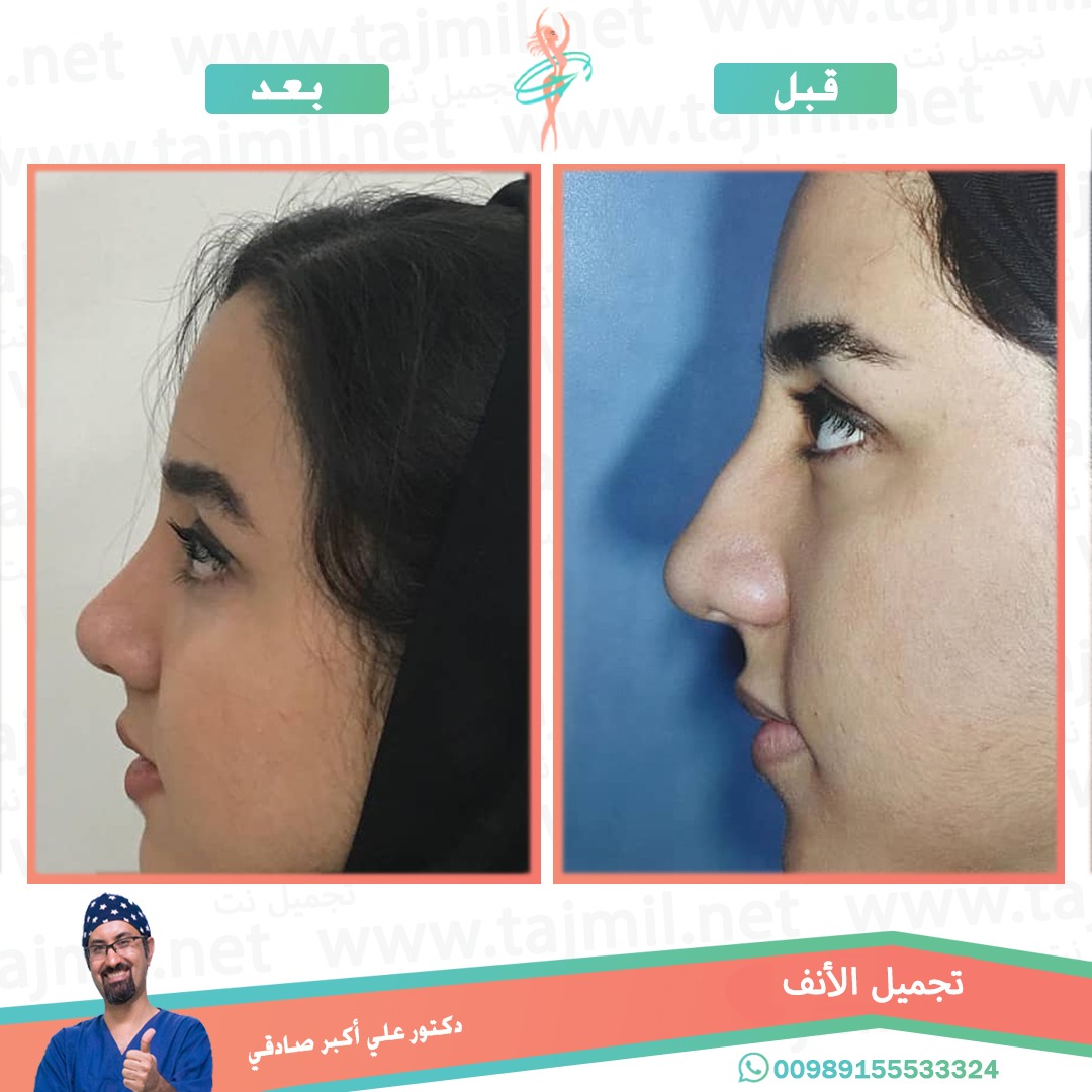  - دكتور علي أکبر صادقي عملية تجميل الانف في ايران مع تجميل نت