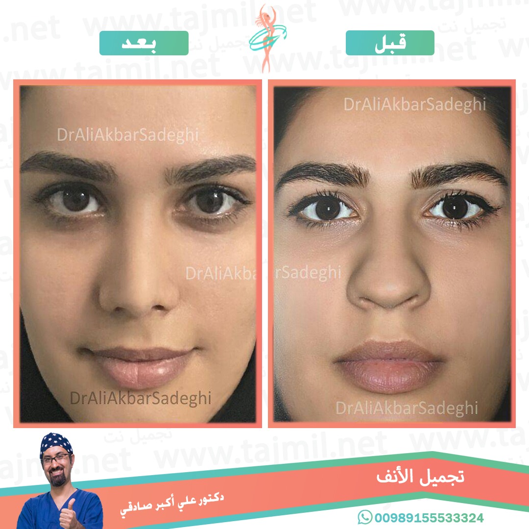  - دكتور علي أکبر صادقي عملية تجميل الانف في ايران مع تجميل نت