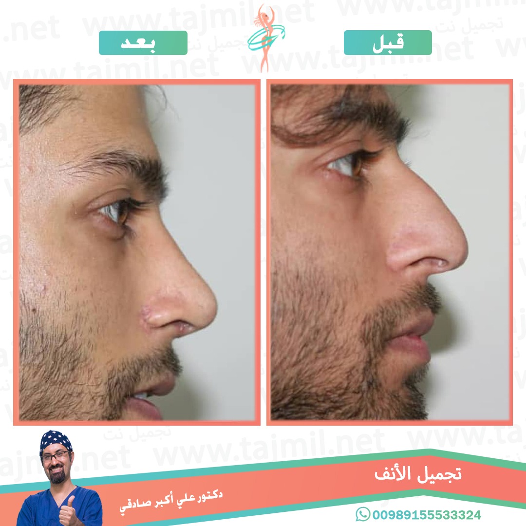  - دكتور علي أکبر صادقي عملية تجميل الانف في ايران مع تجميل نت