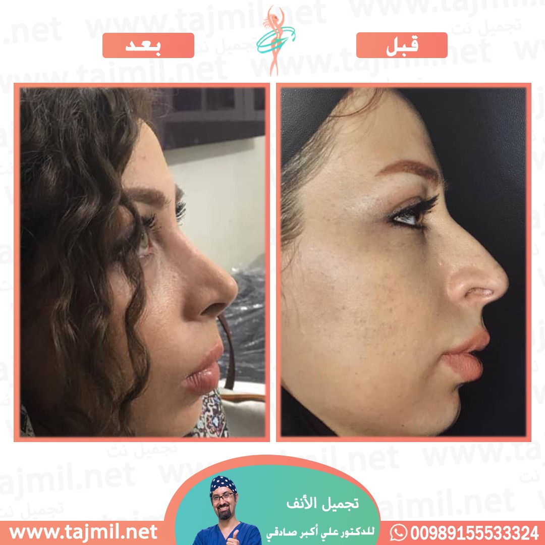  - دكتور علي أکبر صادقي عملية تجميل الانف في ايران مع تجميل نت