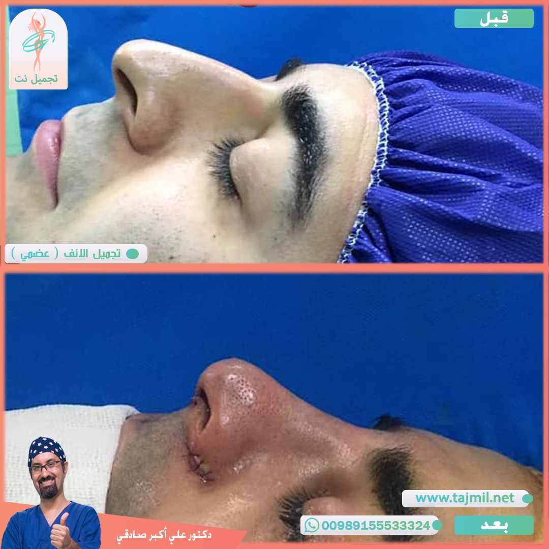  - دكتور علي أکبر صادقي عملية تجميل الانف في ايران مع تجميل نت