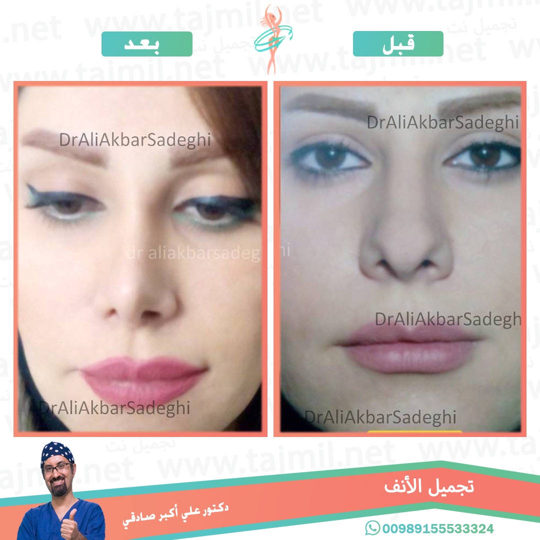  - دكتور علي أکبر صادقي عملية تجميل الانف في ايران مع تجميل نت