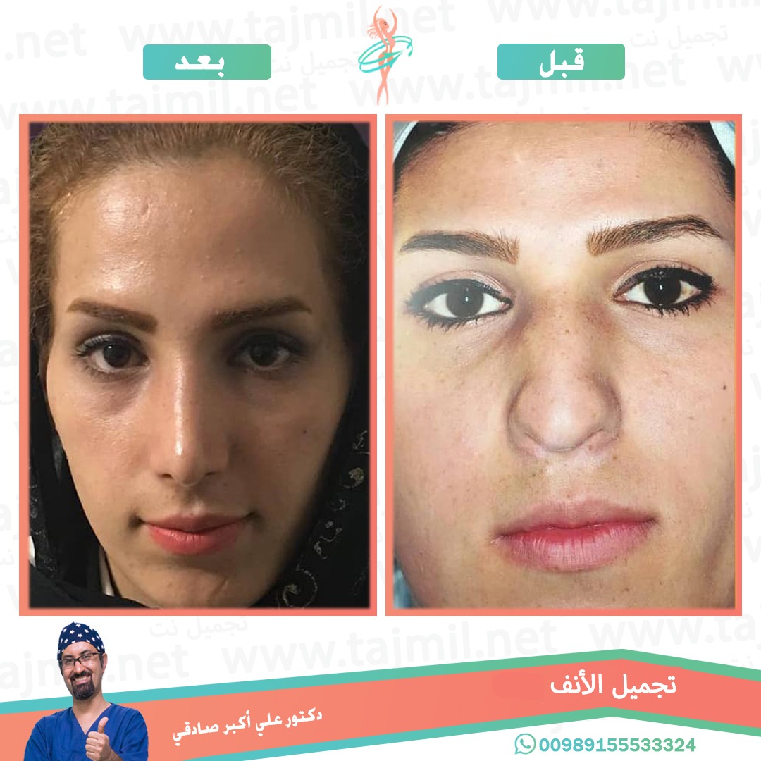  - دكتور علي أکبر صادقي عملية تجميل الانف في ايران مع تجميل نت