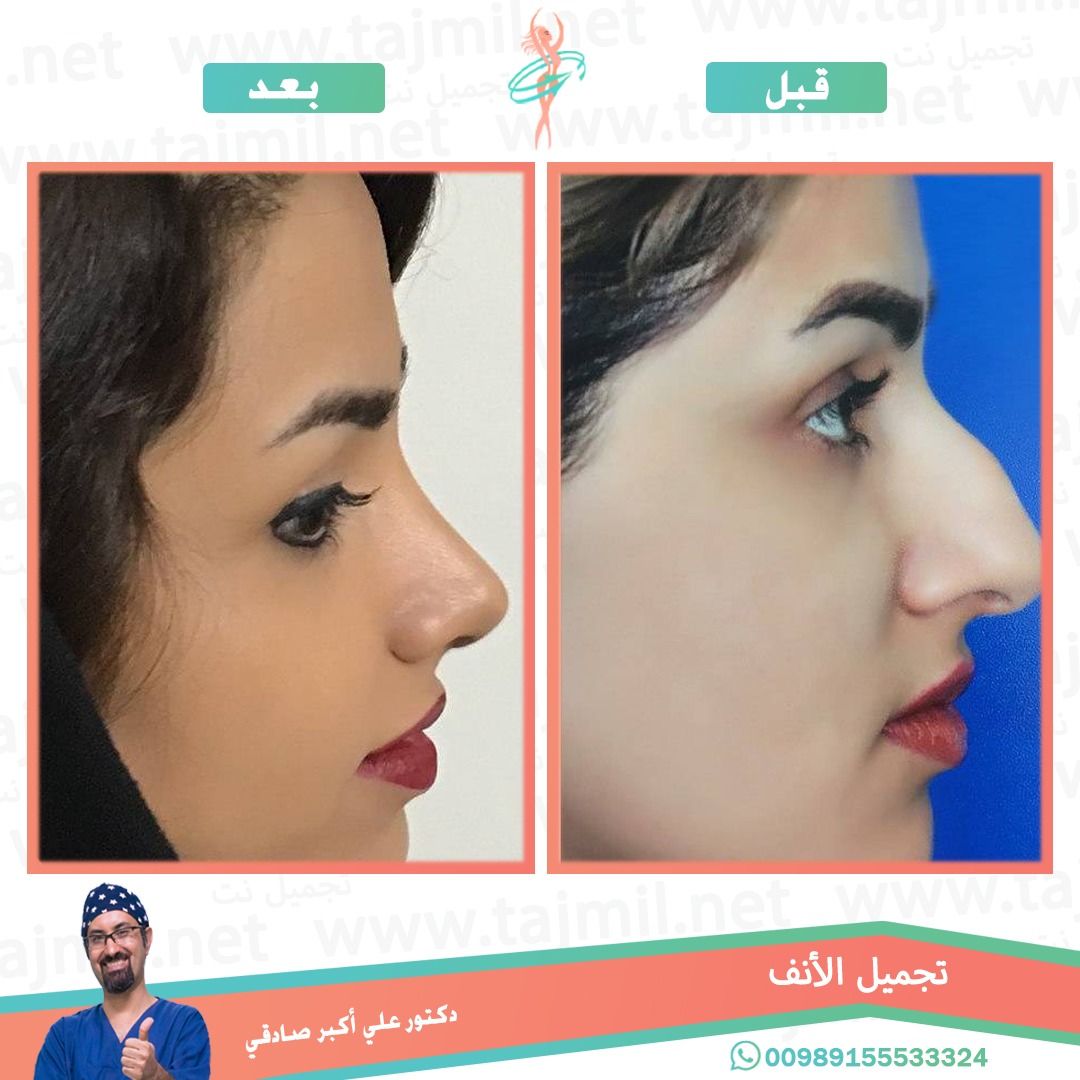  - دكتور علي أکبر صادقي عملية تجميل الانف في ايران مع تجميل نت