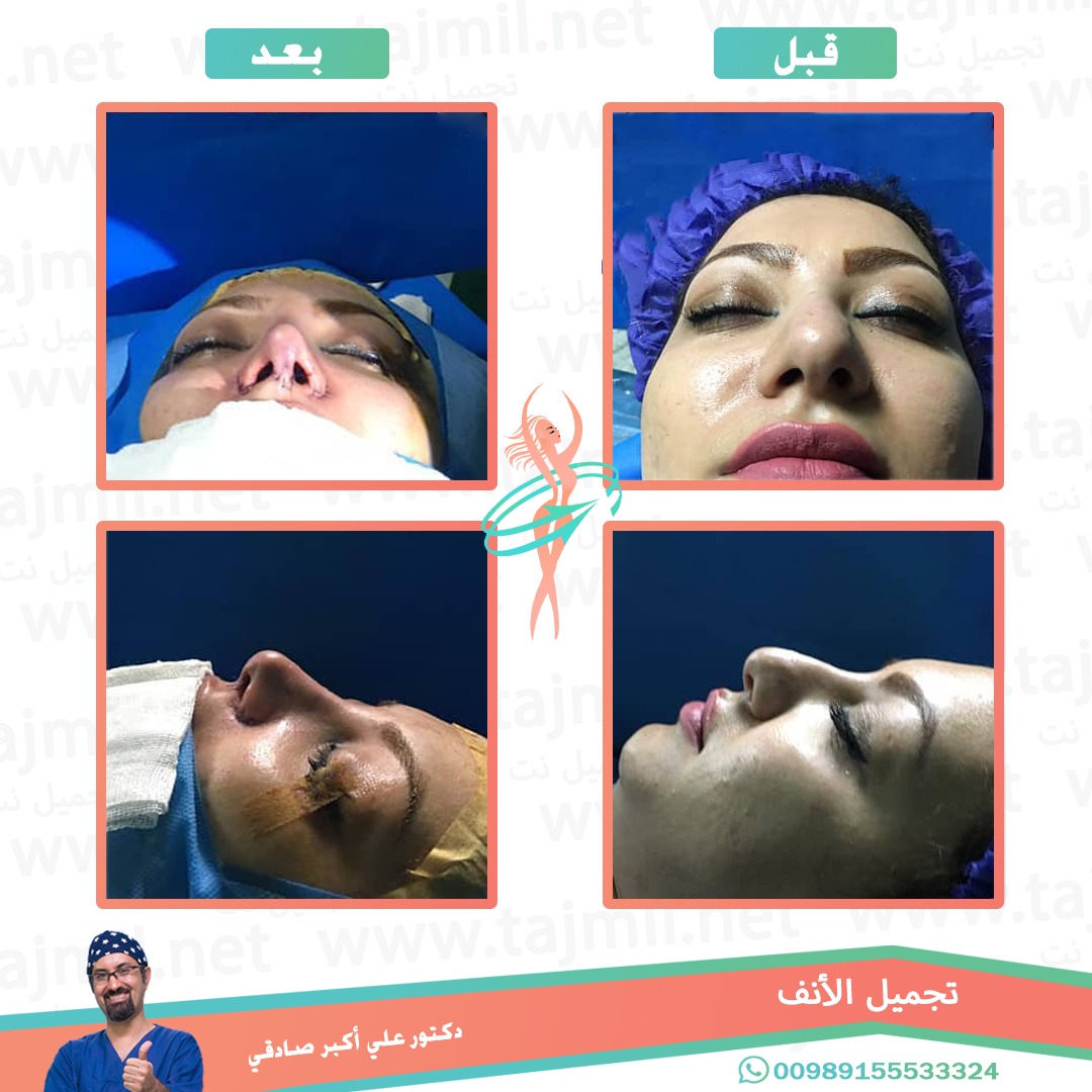  - دكتور علي أکبر صادقي عملية تجميل الانف في ايران مع تجميل نت