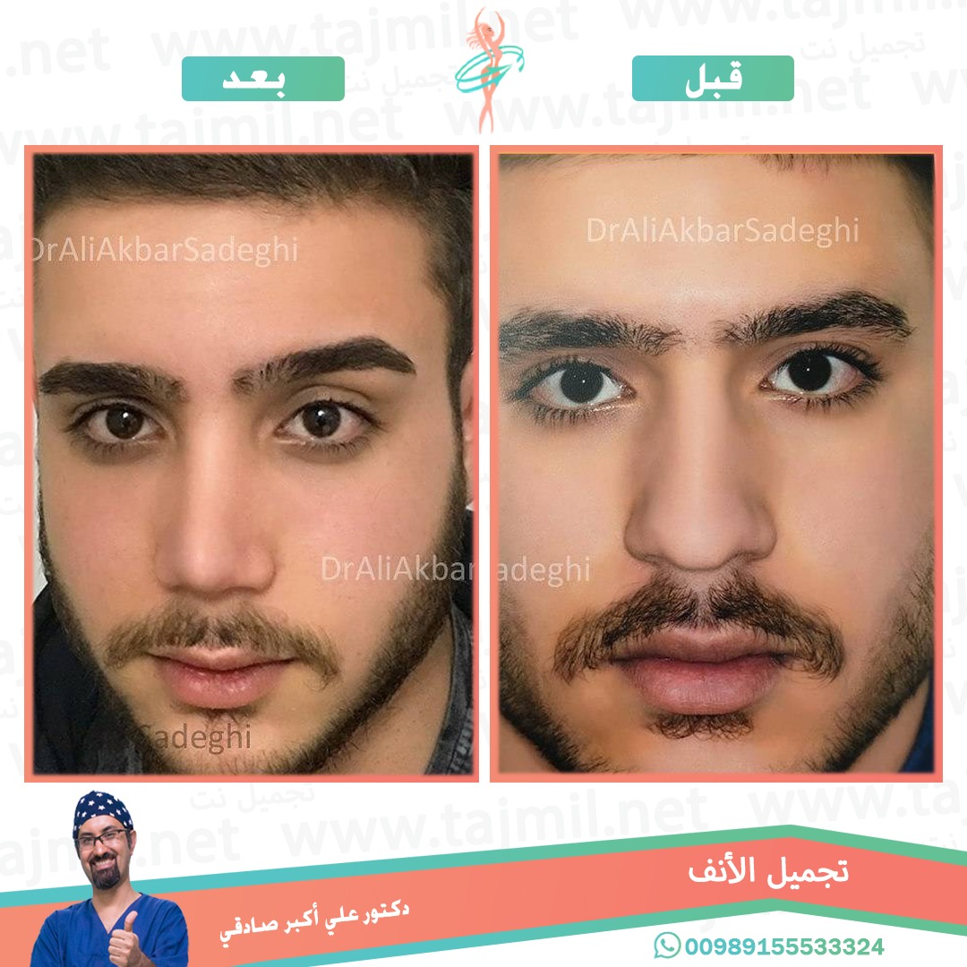  - دكتور علي أکبر صادقي عملية تجميل الانف في ايران مع تجميل نت