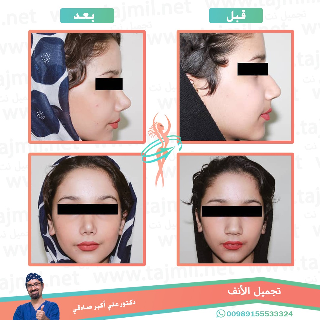  - دكتور علي أکبر صادقي عملية تجميل الانف في ايران مع تجميل نت