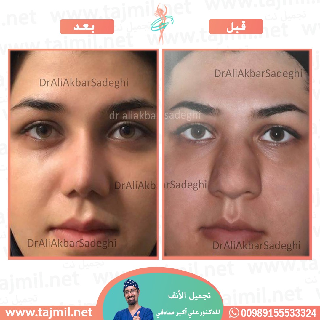  - دكتور علي أکبر صادقي عملية تجميل الانف في ايران مع تجميل نت