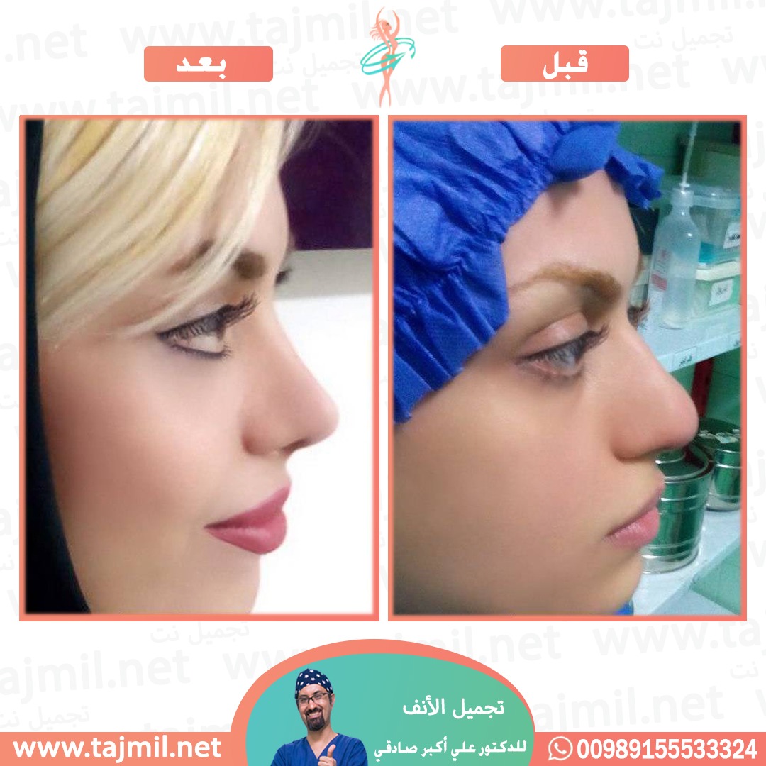  - دكتور علي أکبر صادقي عملية تجميل الانف في ايران مع تجميل نت