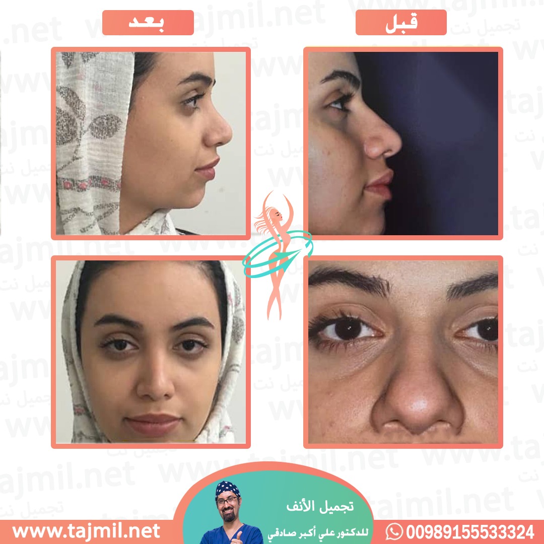  - دكتور علي أکبر صادقي عملية تجميل الانف في ايران مع تجميل نت