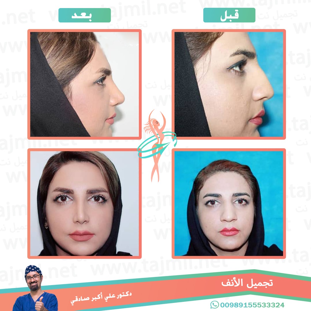  - دكتور علي أکبر صادقي عملية تجميل الانف في ايران مع تجميل نت