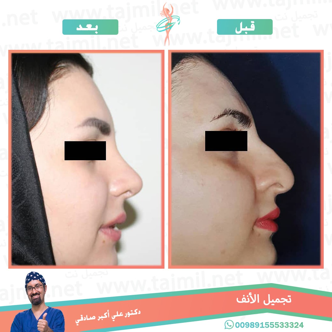  - دكتور علي أکبر صادقي عملية تجميل الانف في ايران مع تجميل نت