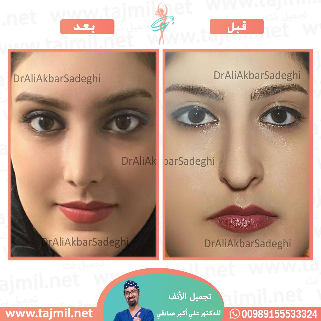  - دكتور علي أکبر صادقي عملية تجميل الانف في ايران مع تجميل نت