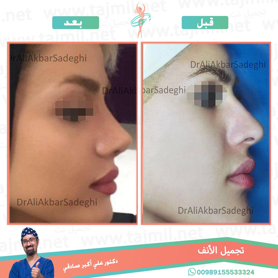  - دكتور علي أکبر صادقي عملية تجميل الانف في ايران مع تجميل نت