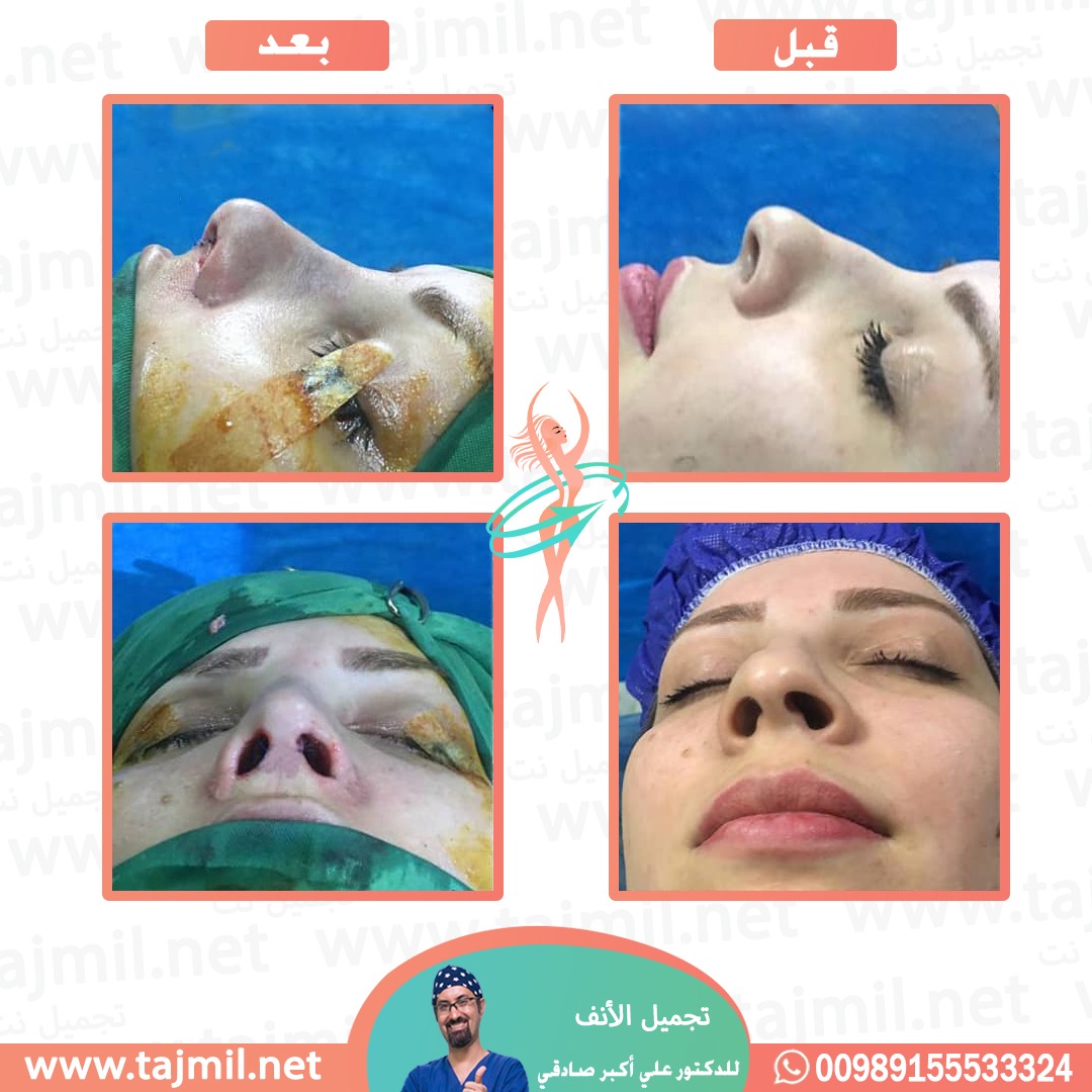  - دكتور علي أکبر صادقي عملية تجميل الانف في ايران مع تجميل نت