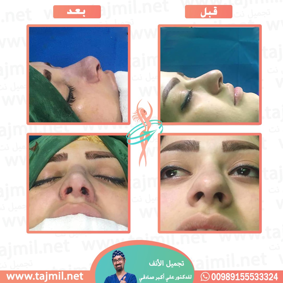  - دكتور علي أکبر صادقي عملية تجميل الانف في ايران مع تجميل نت