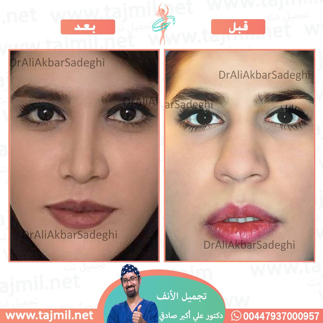  - دكتور علي أکبر صادقي عملية تجميل الانف في ايران مع تجميل نت