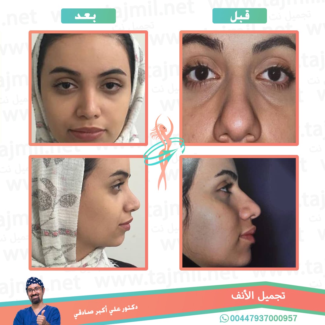  - دكتور علي أکبر صادقي عملية تجميل الانف في ايران مع تجميل نت