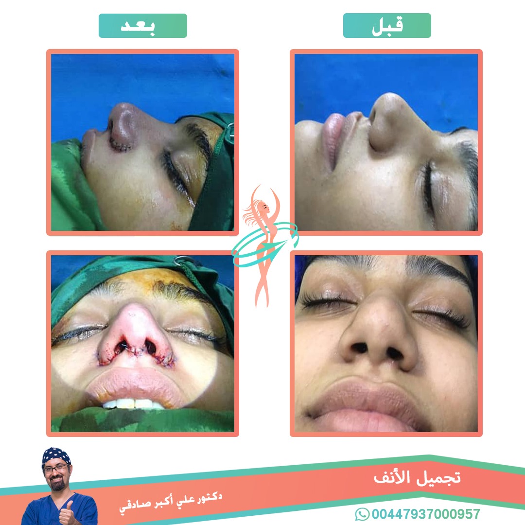  - دكتور علي أکبر صادقي عملية تجميل الانف في ايران مع تجميل نت