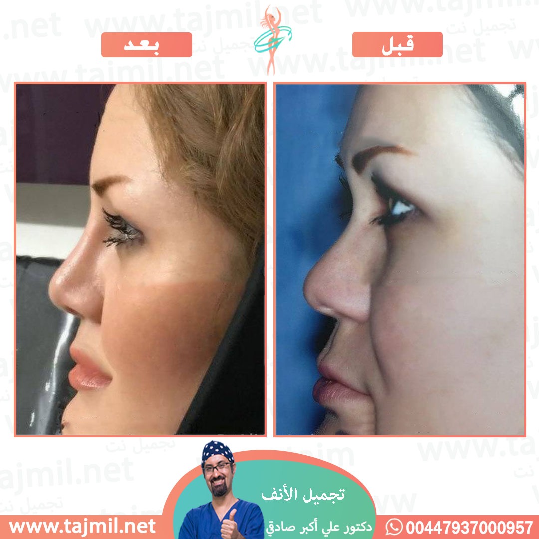  - دكتور علي أکبر صادقي عملية تجميل الانف في ايران مع تجميل نت