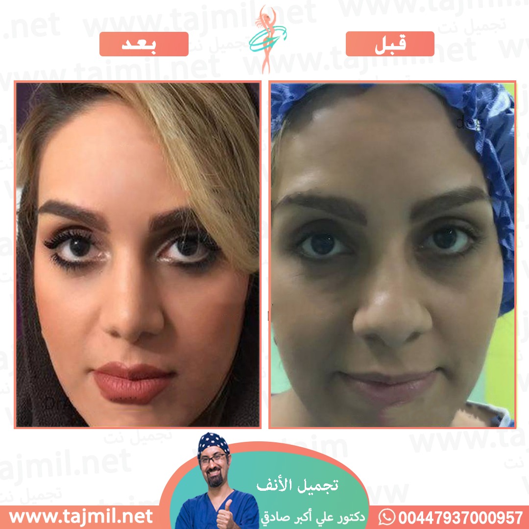  - دكتور علي أکبر صادقي عملية تجميل الانف في ايران مع تجميل نت