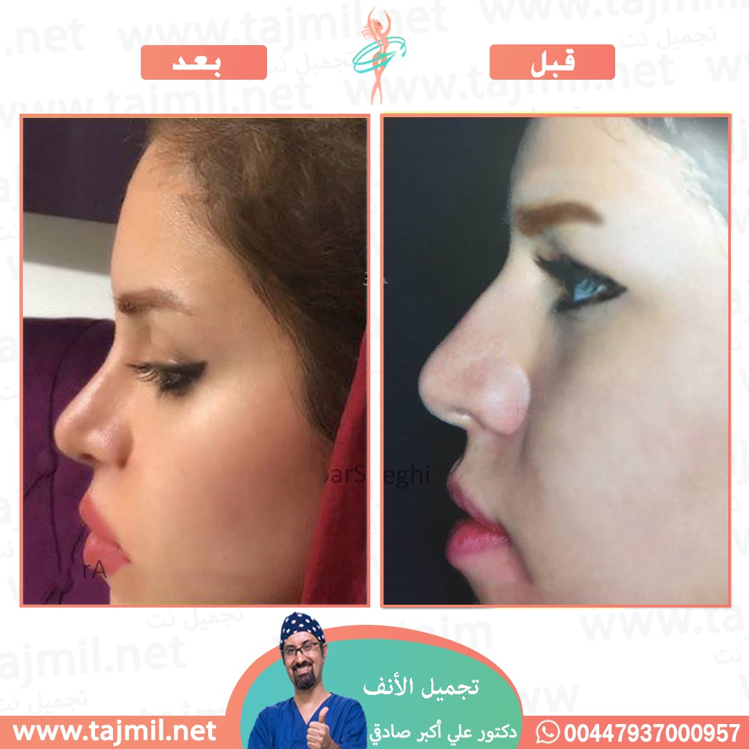  - دكتور علي أکبر صادقي عملية تجميل الانف في ايران مع تجميل نت