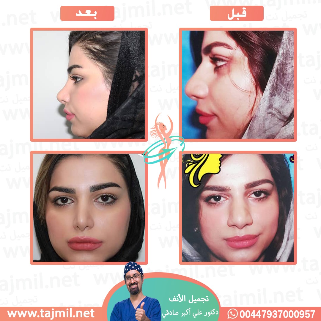  - دكتور علي أکبر صادقي عملية تجميل الانف في ايران مع تجميل نت