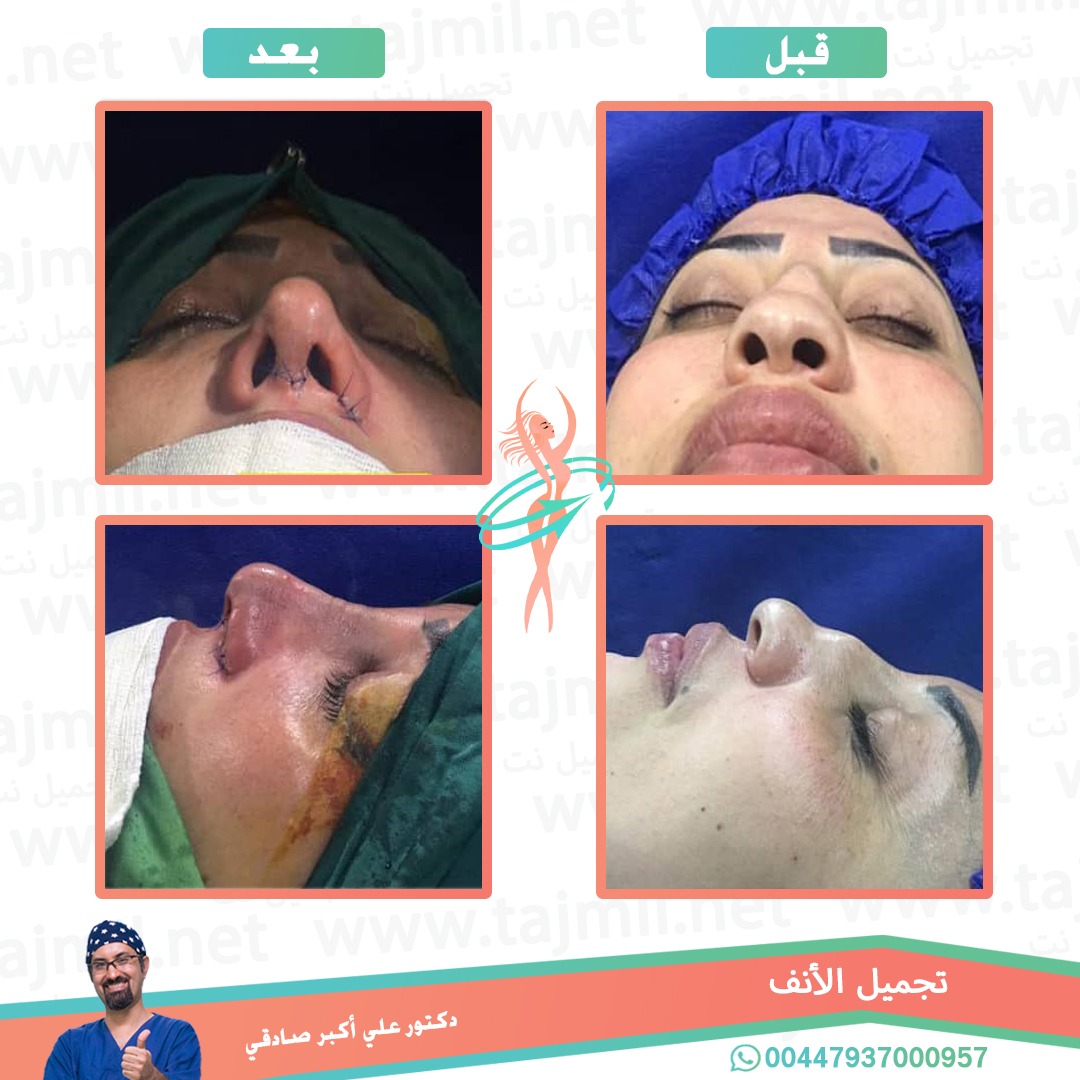  - دكتور علي أکبر صادقي عملية تجميل الانف في ايران مع تجميل نت