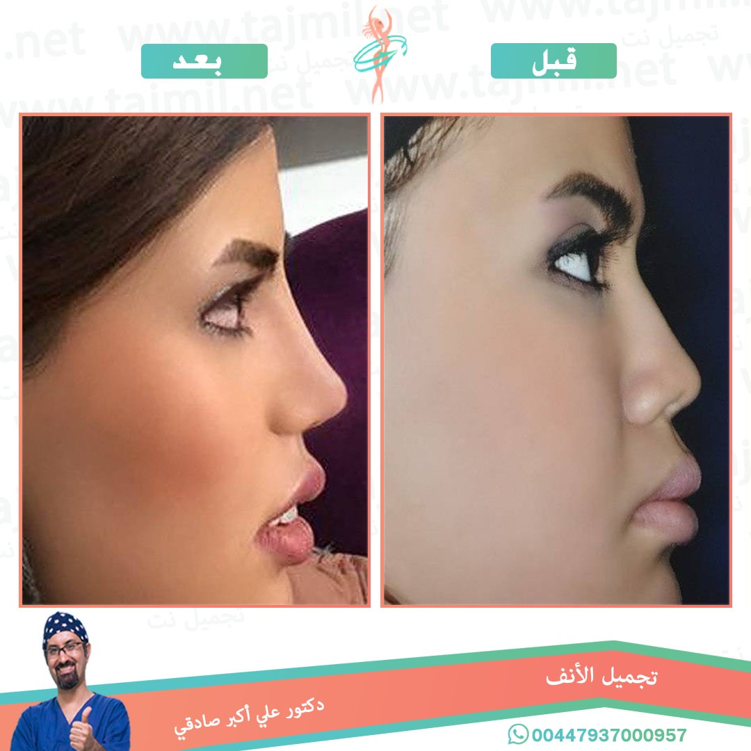  - دكتور علي أکبر صادقي عملية تجميل الانف في ايران مع تجميل نت