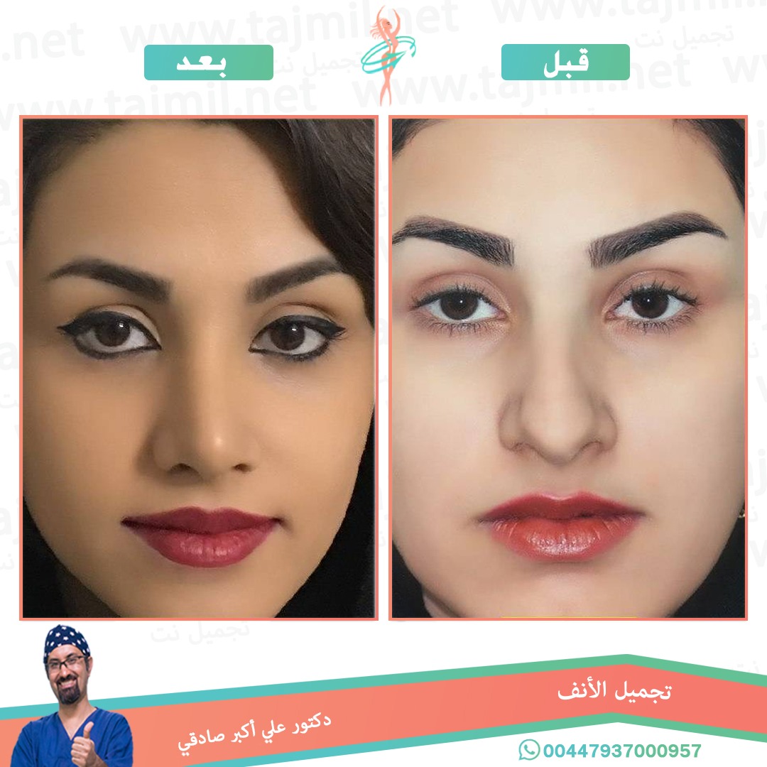  - دكتور علي أکبر صادقي عملية تجميل الانف في ايران مع تجميل نت