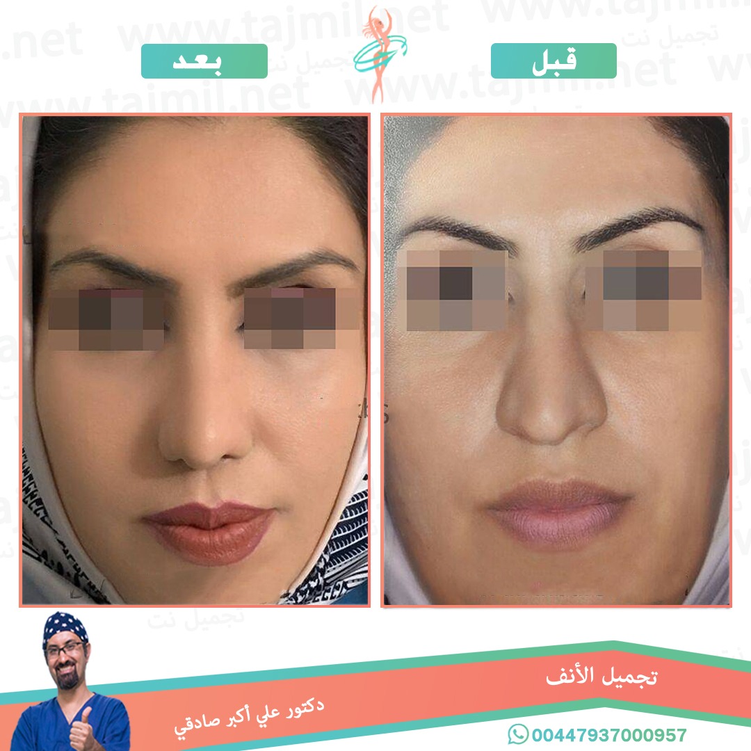  - دكتور علي أکبر صادقي عملية تجميل الانف في ايران مع تجميل نت