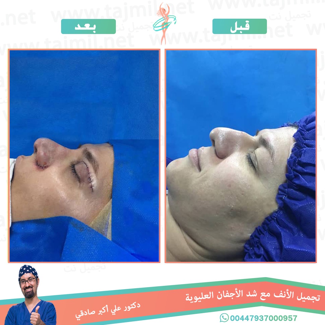  - دكتور علي أکبر صادقي عملية تجميل الانف في ايران مع تجميل نت