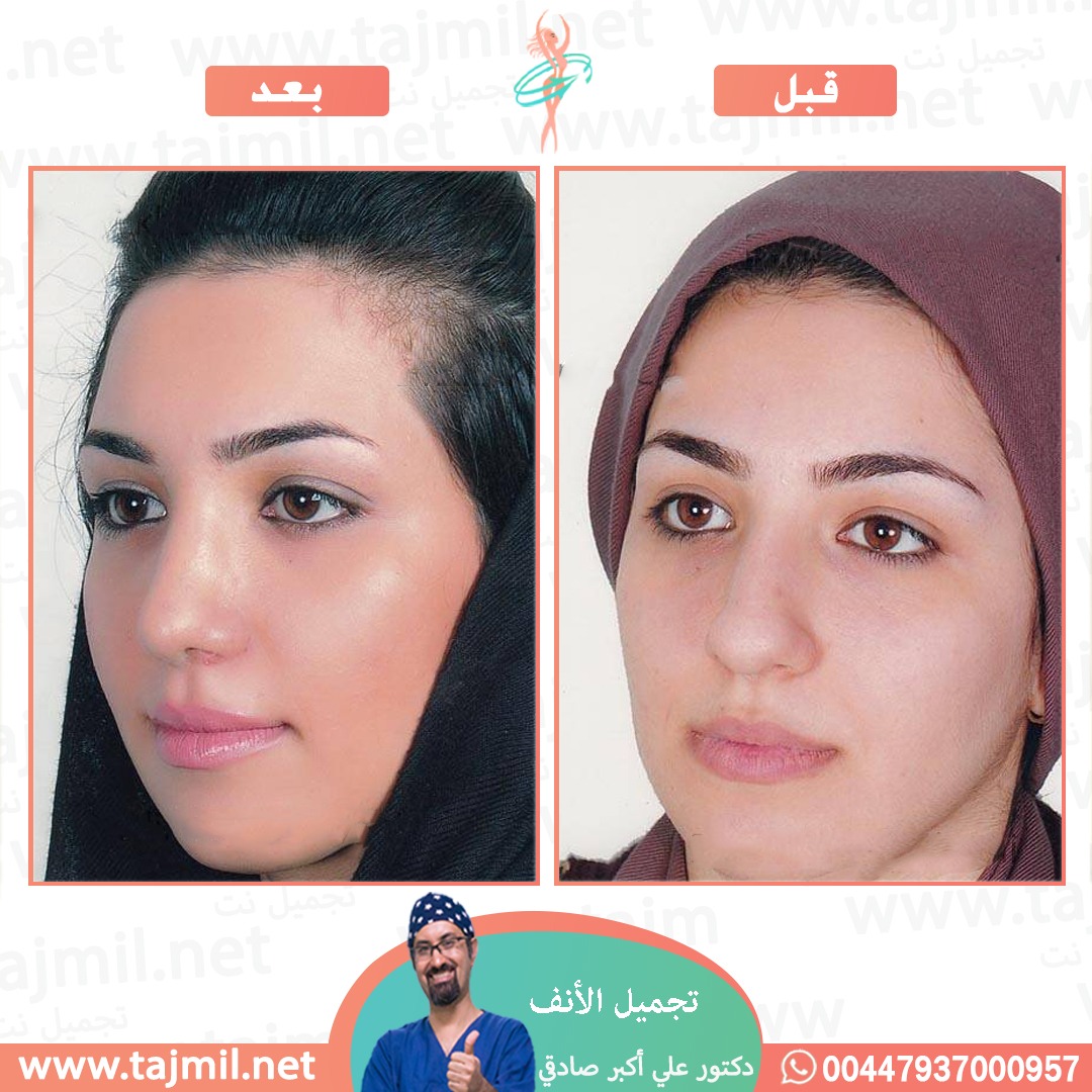  - دكتور علي أکبر صادقي عملية تجميل الانف في ايران مع تجميل نت