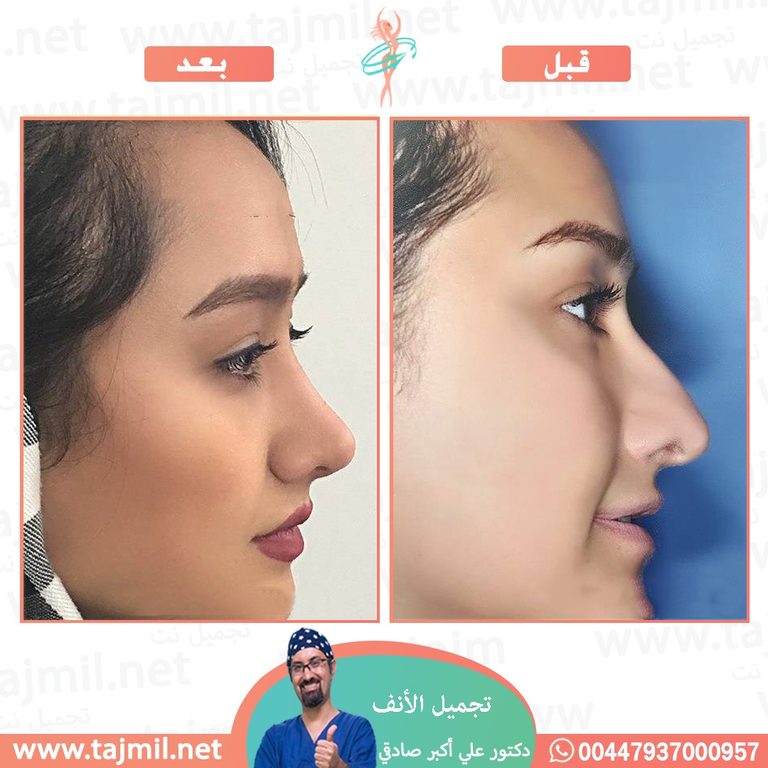  - دكتور علي أکبر صادقي عملية تجميل الانف في ايران مع تجميل نت