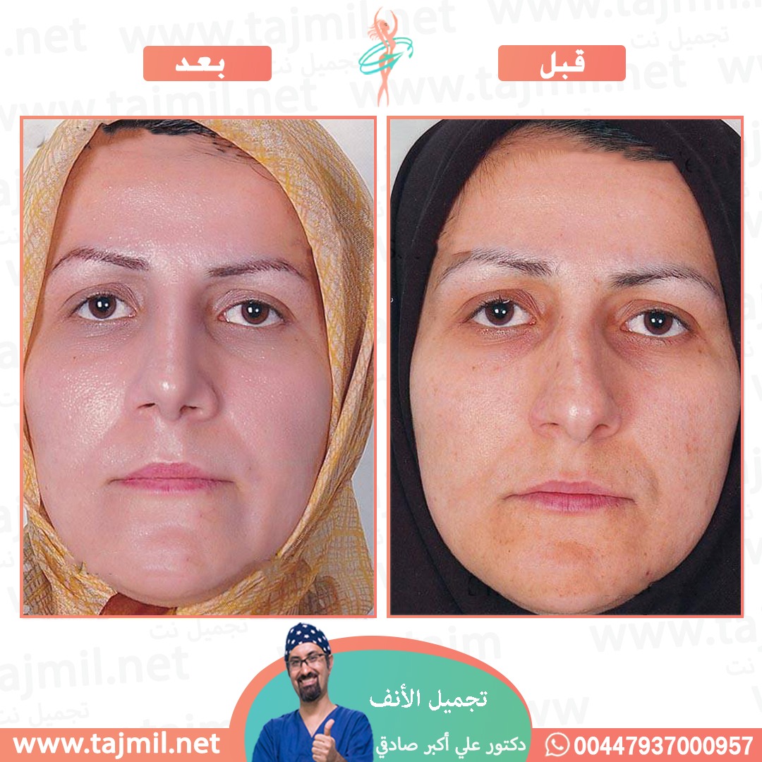  - دكتور علي أکبر صادقي عملية تجميل الانف في ايران مع تجميل نت