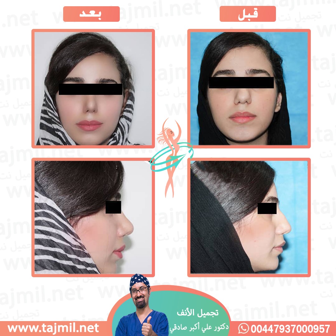  - دكتور علي أکبر صادقي عملية تجميل الانف في ايران مع تجميل نت