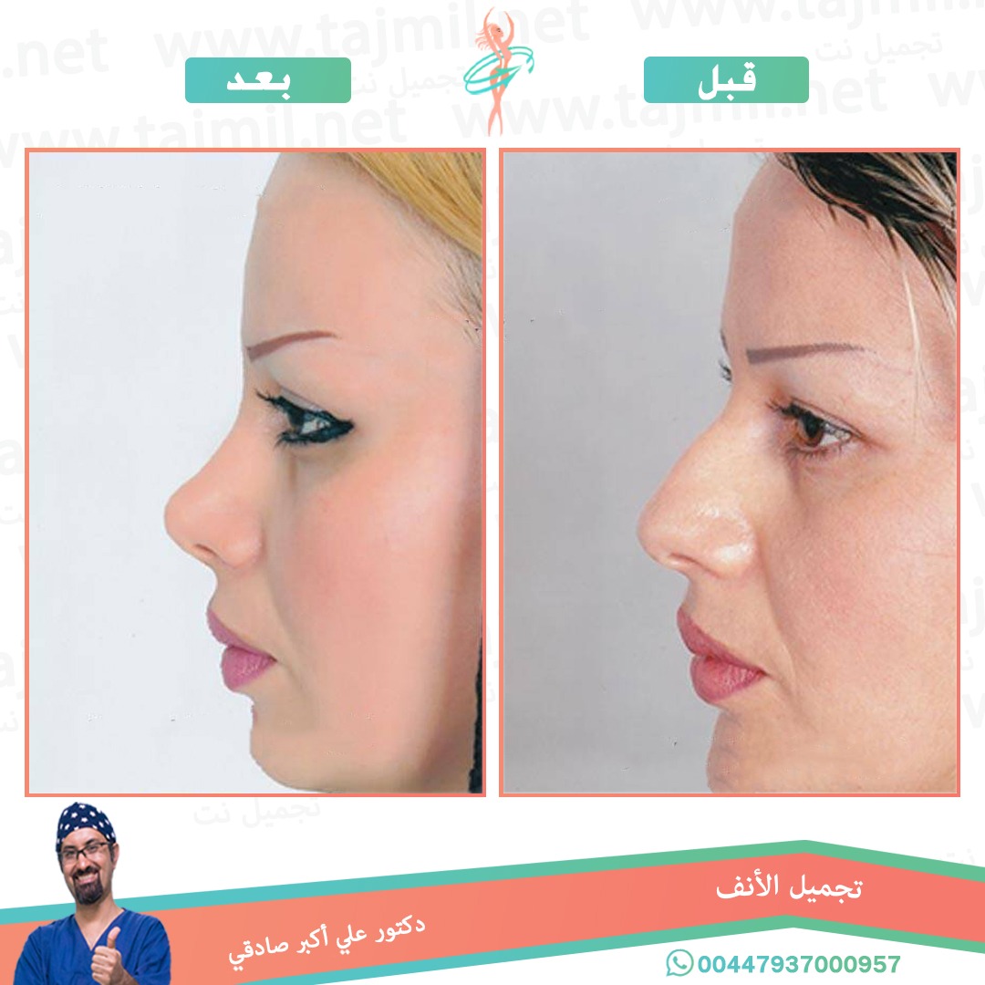  - دكتور علي أکبر صادقي عملية تجميل الانف في ايران مع تجميل نت