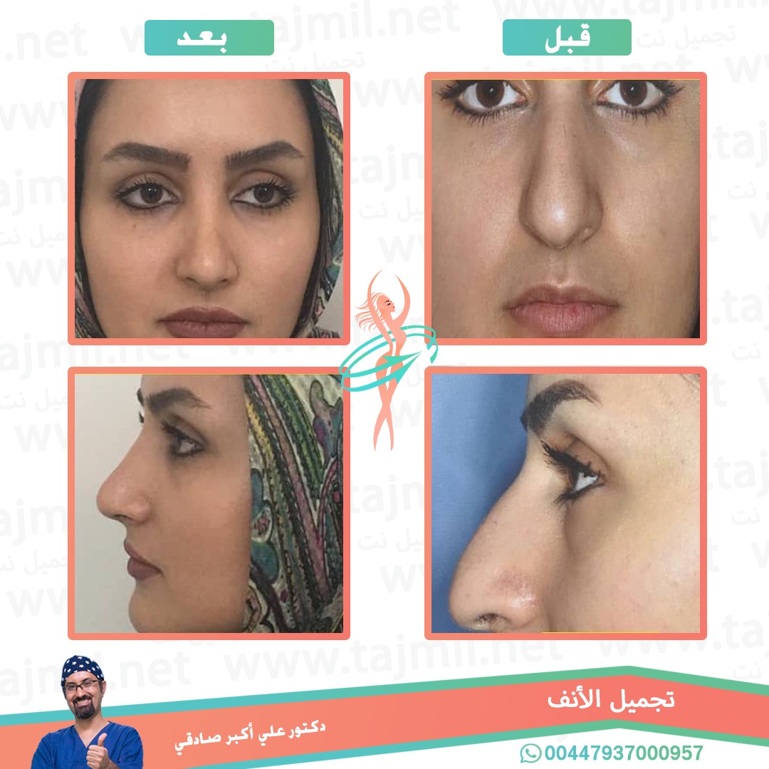  - دكتور علي أکبر صادقي عملية تجميل الانف في ايران مع تجميل نت