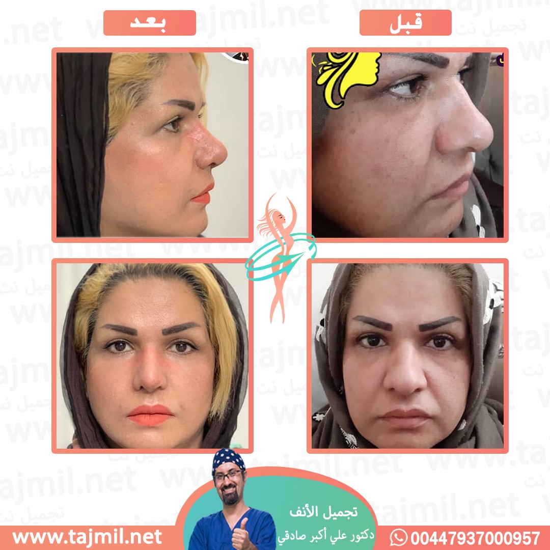  - دكتور علي أکبر صادقي عملية تجميل الانف في ايران مع تجميل نت