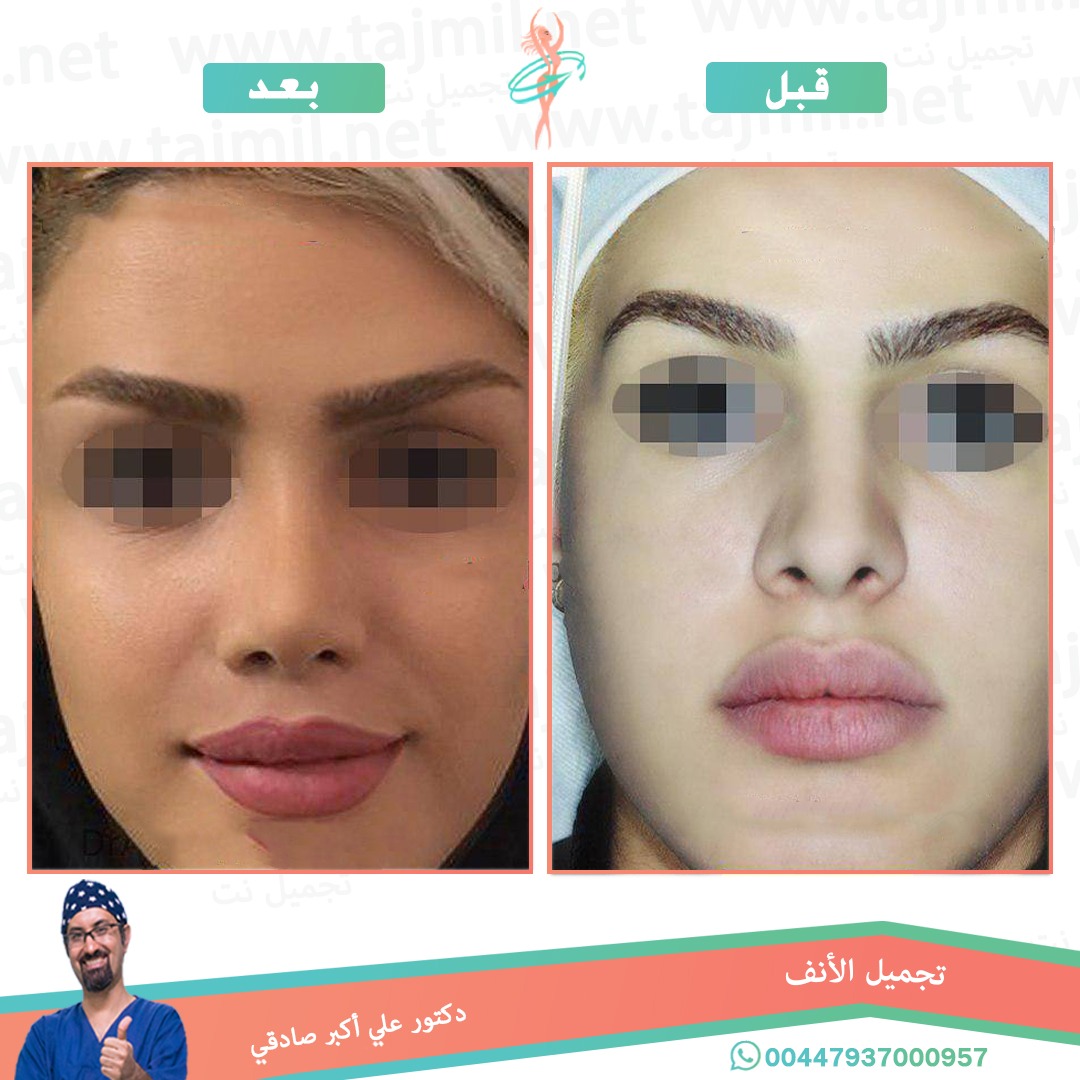  - دكتور علي أکبر صادقي عملية تجميل الانف في ايران مع تجميل نت