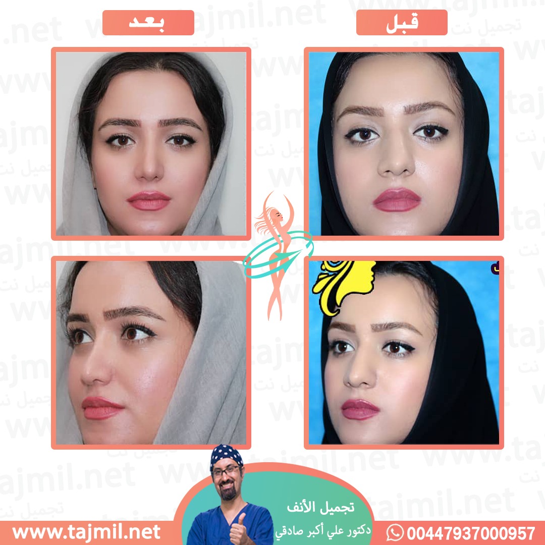  - دكتور علي أکبر صادقي عملية تجميل الانف في ايران مع تجميل نت