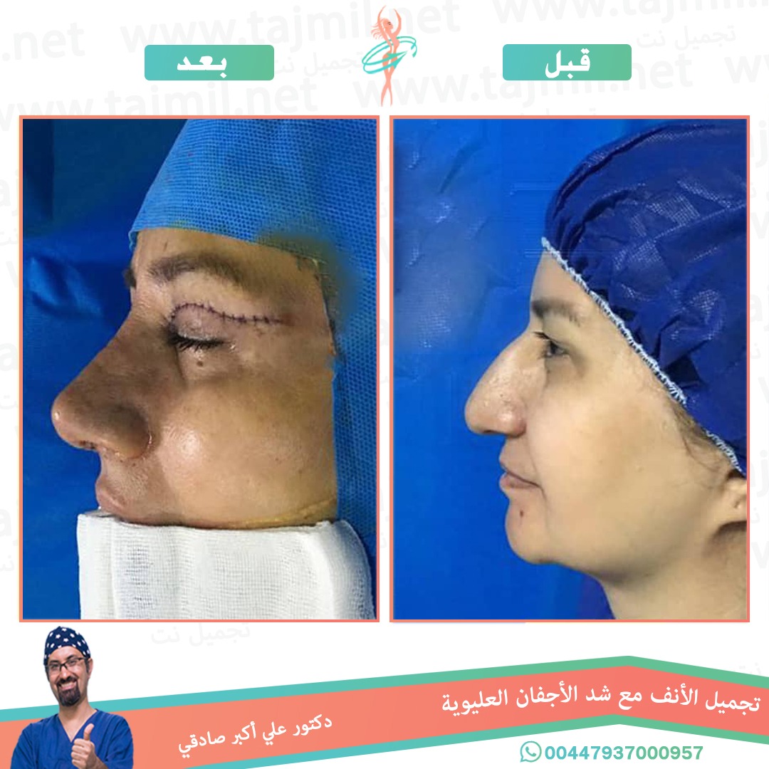  - دكتور علي أکبر صادقي عملية تجميل الانف مع شد الآجفان في ايران مع تجميل نت