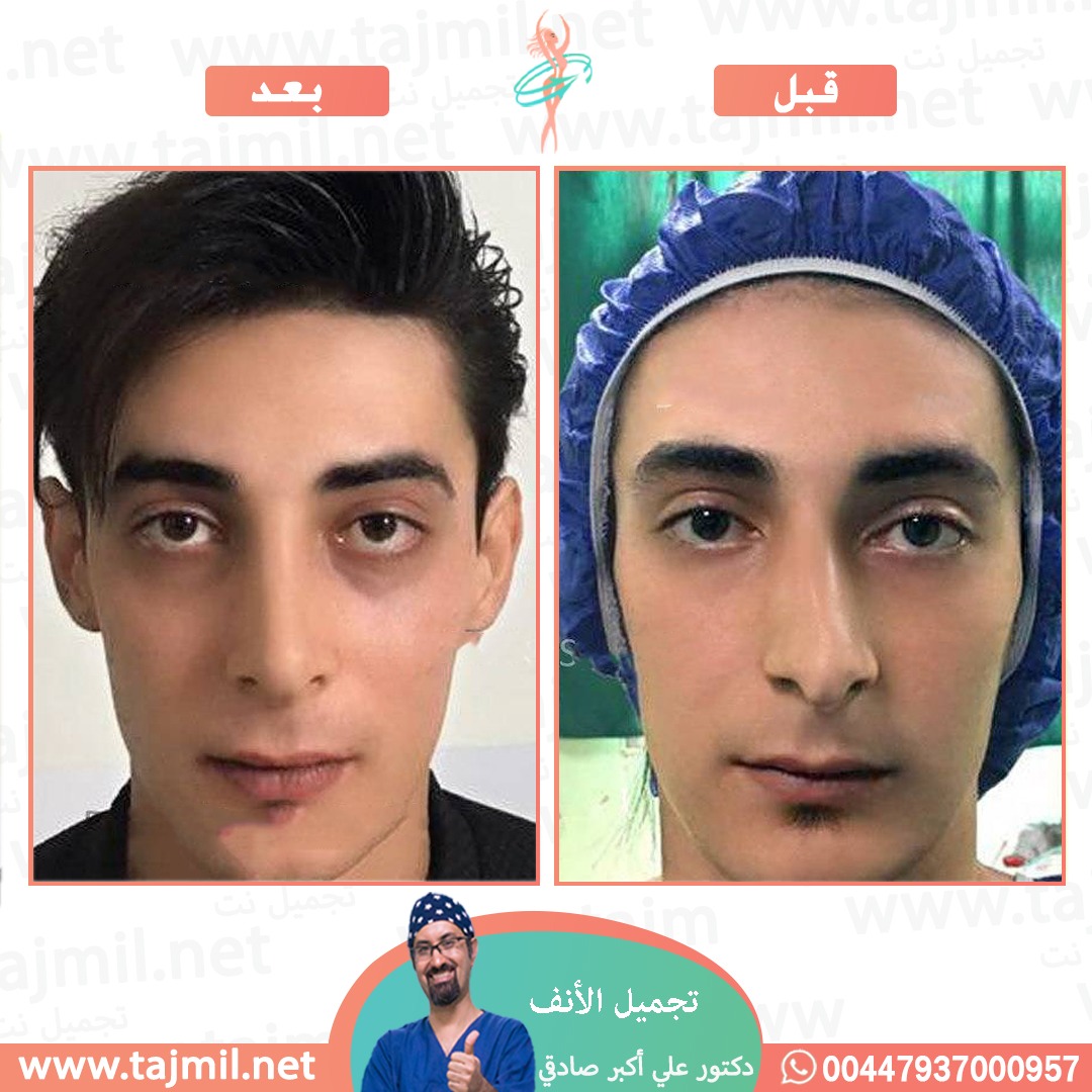  - دكتور علي أکبر صادقي عملية تجميل الانف في ايران مع تجميل نت