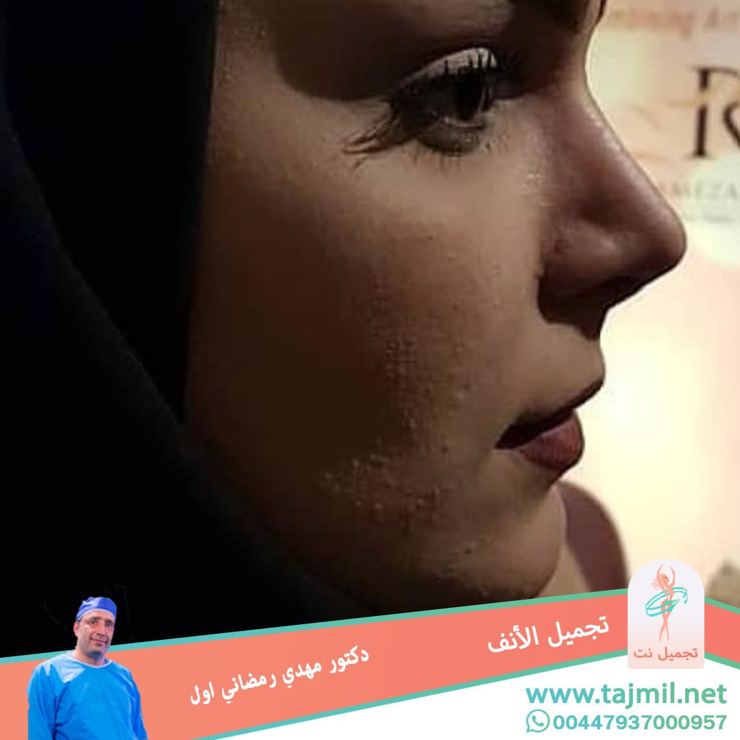  - دكتور مهدي رمضاني اول عملية تجميل الانف في ايران مع تجميل نت