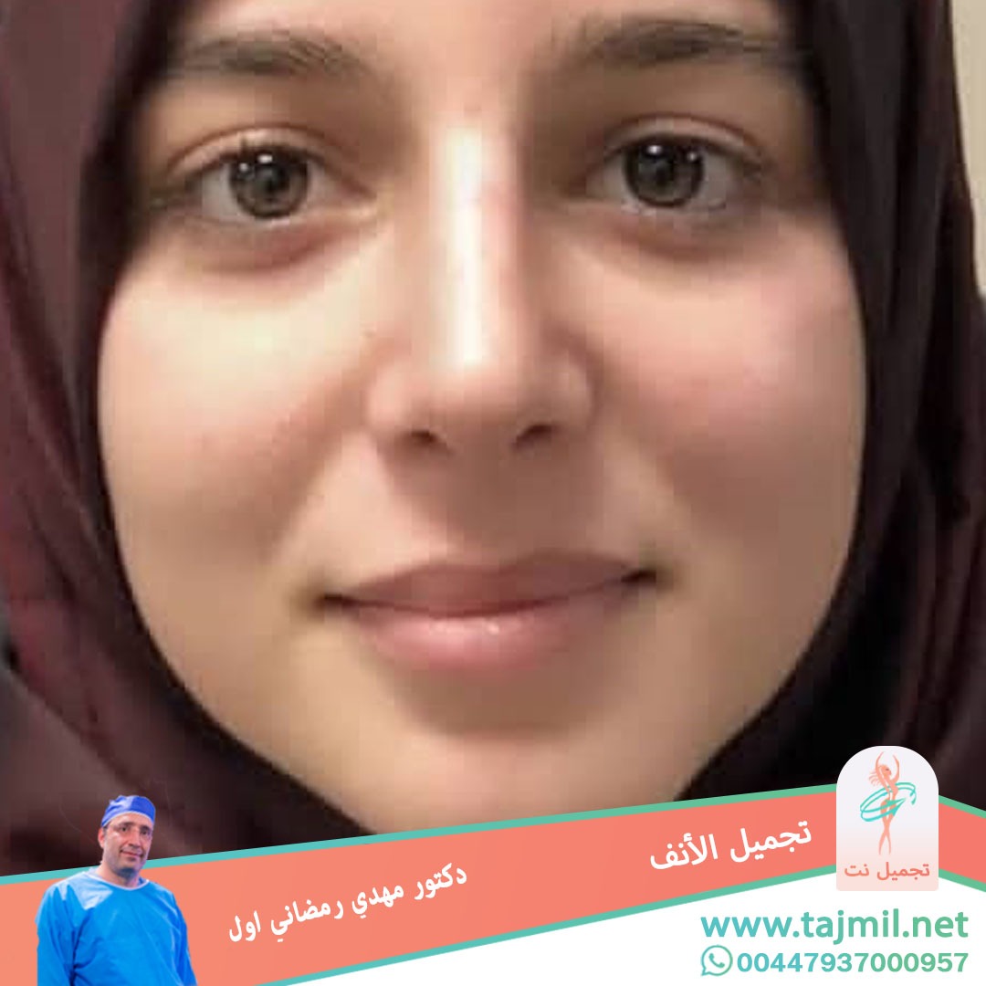  - دكتور مهدي رمضاني اول عملية تجميل الانف في ايران مع تجميل نت